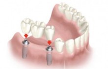 Implantes dentales, Barranquilla